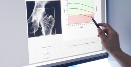 Investigadores da ULS São João destacam importância da histomorfometria óssea no tratamento da doença óssea metabólica
