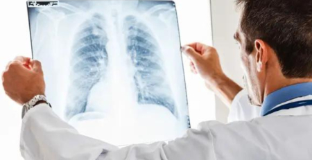 IPP melhoram sobrevivência na doença pulmonar intersticial associada à esclerose sistémica